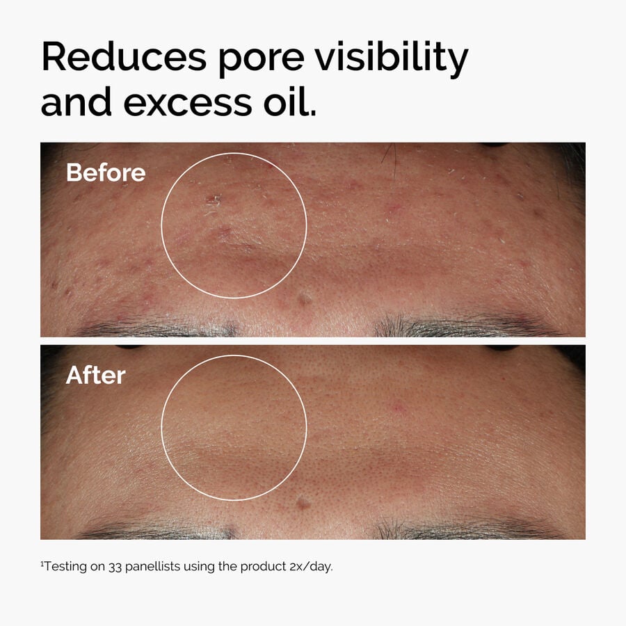 niacinamide-10-zinc-1-j7 ord-niacinamide-zinc-blemish-serum-before-after-pores.jpg