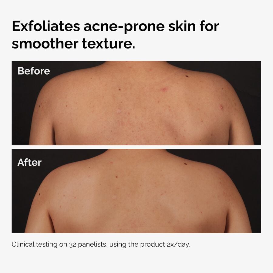 the-body-care-collection-v1 ord-salicylic-acid-body-serum-before-after-graphic-NA.jpg