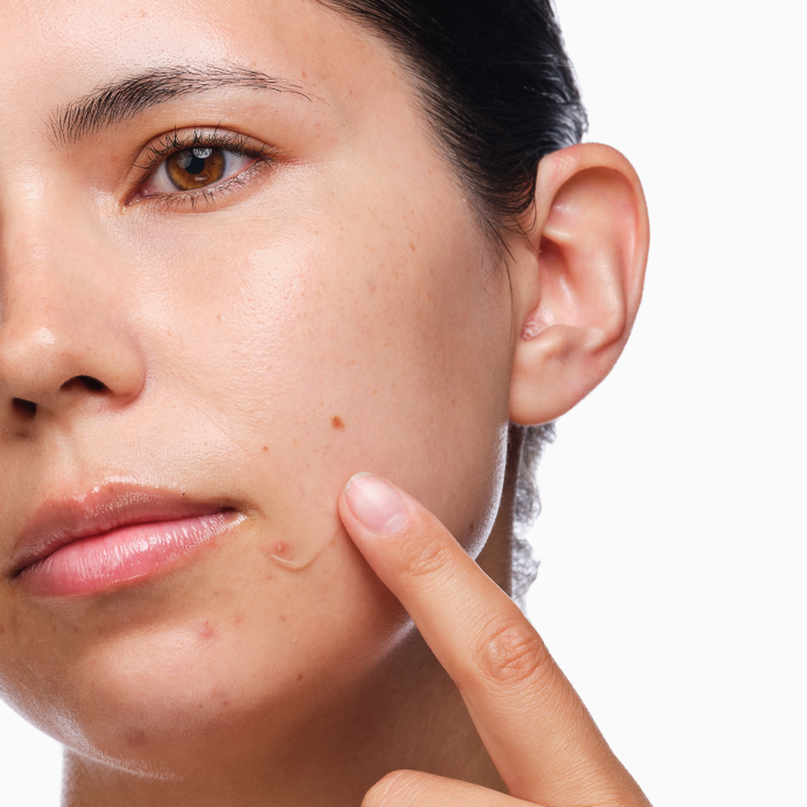 the-acne-set-t0 rdn-the-acne-set-application.png
